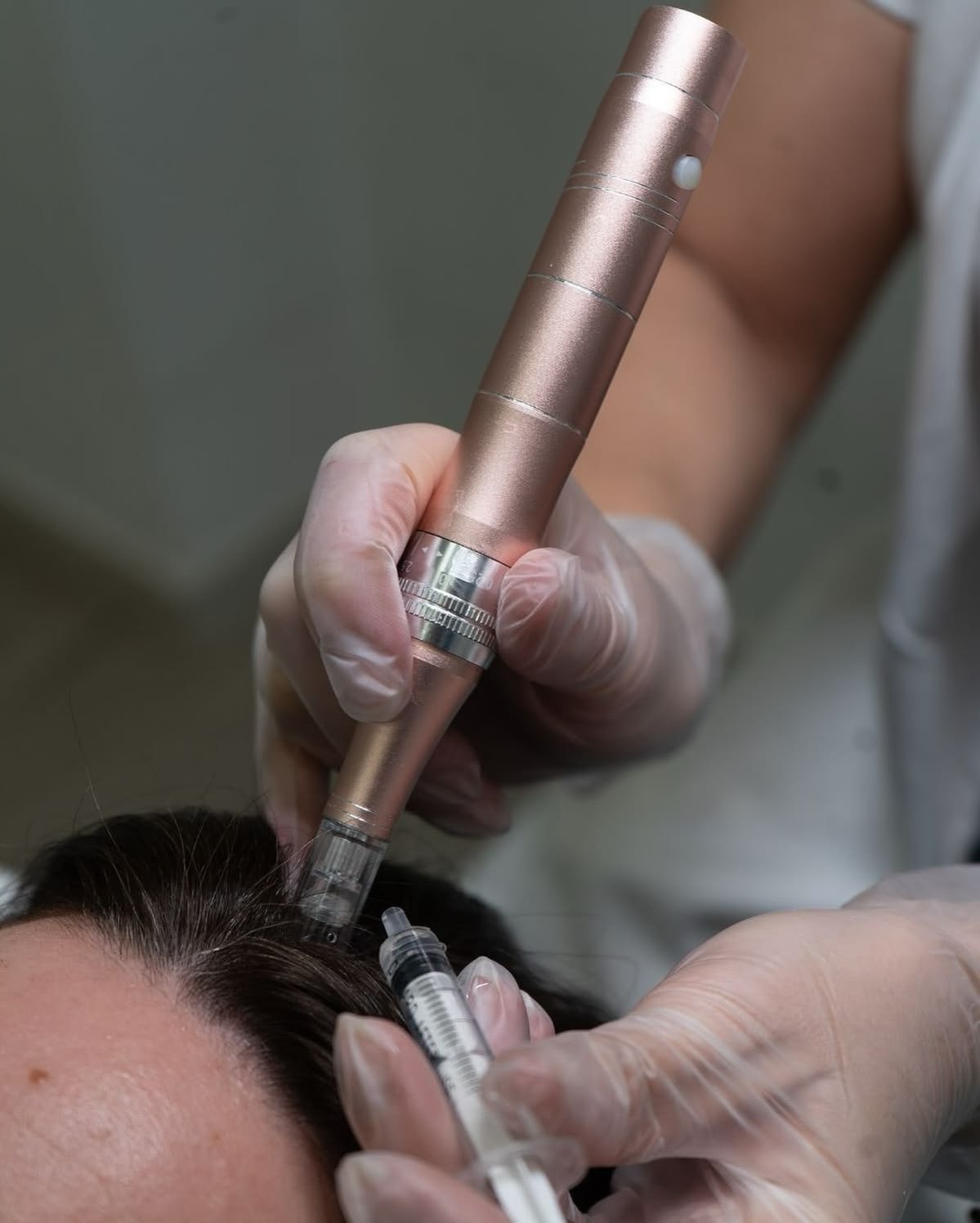 Saç Mezoterapisi – klinik tedavi galeri görseli 1