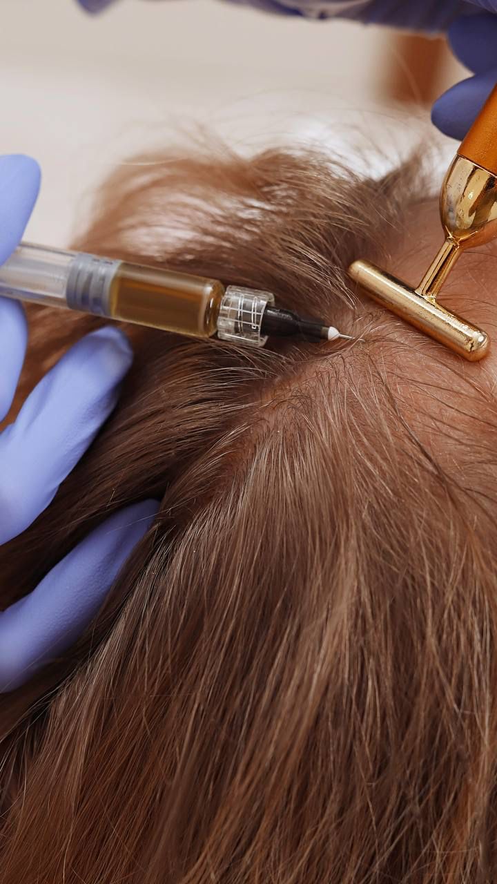 Saç Mezoterapisi – klinik tedavi galeri görseli 2