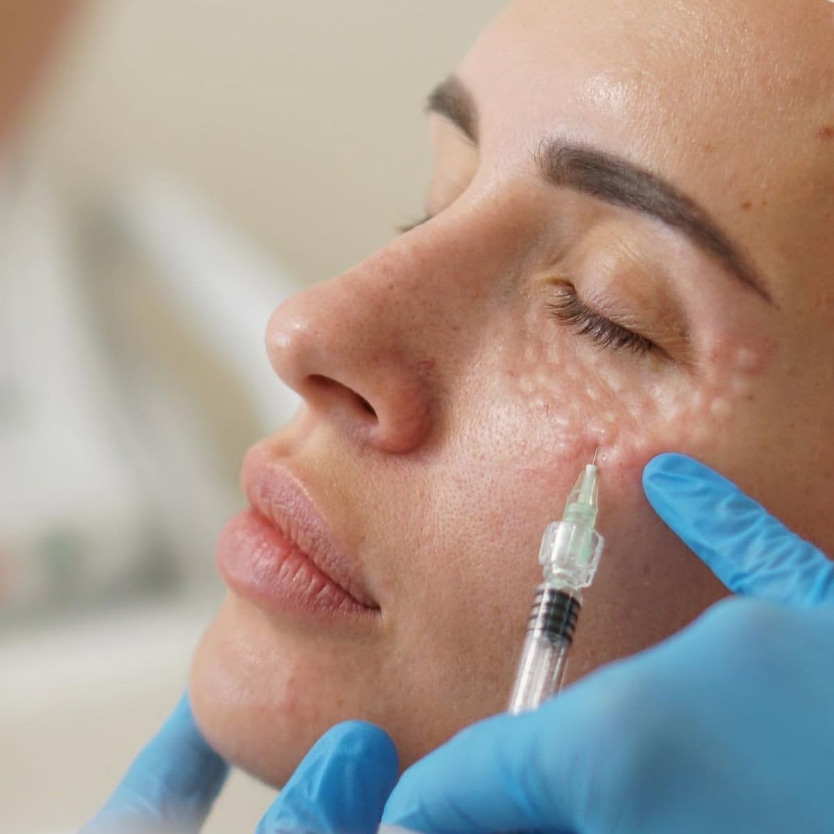 Yüz Dolgusu – klinik tedavi galeri görseli 2
