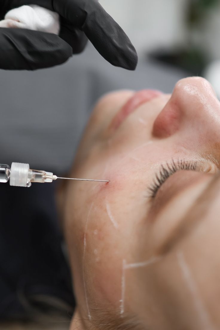 Ameliyatsız Cilt Gençleştirme – klinik tedavi galeri görseli 1
