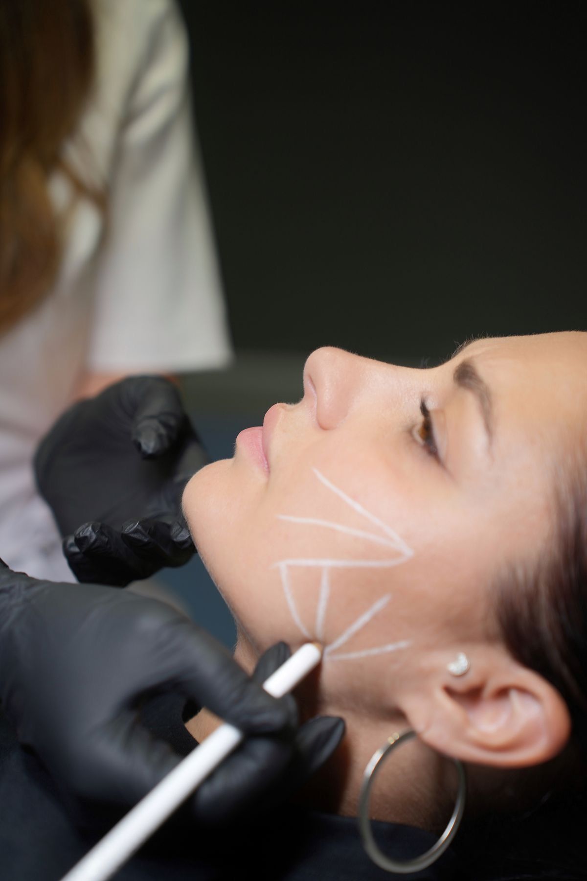 Ameliyatsız Cilt Gençleştirme – klinik tedavi galeri görseli 2