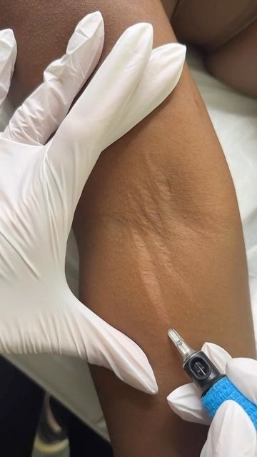 Yara izi tedavisi klinik görseli