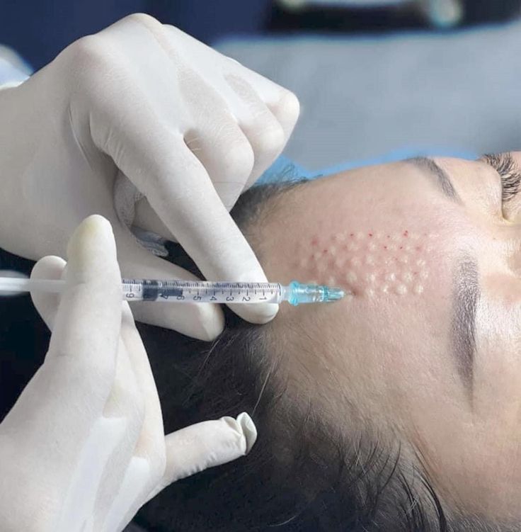 Mezoterapi – klinik tedavi galeri görseli 2