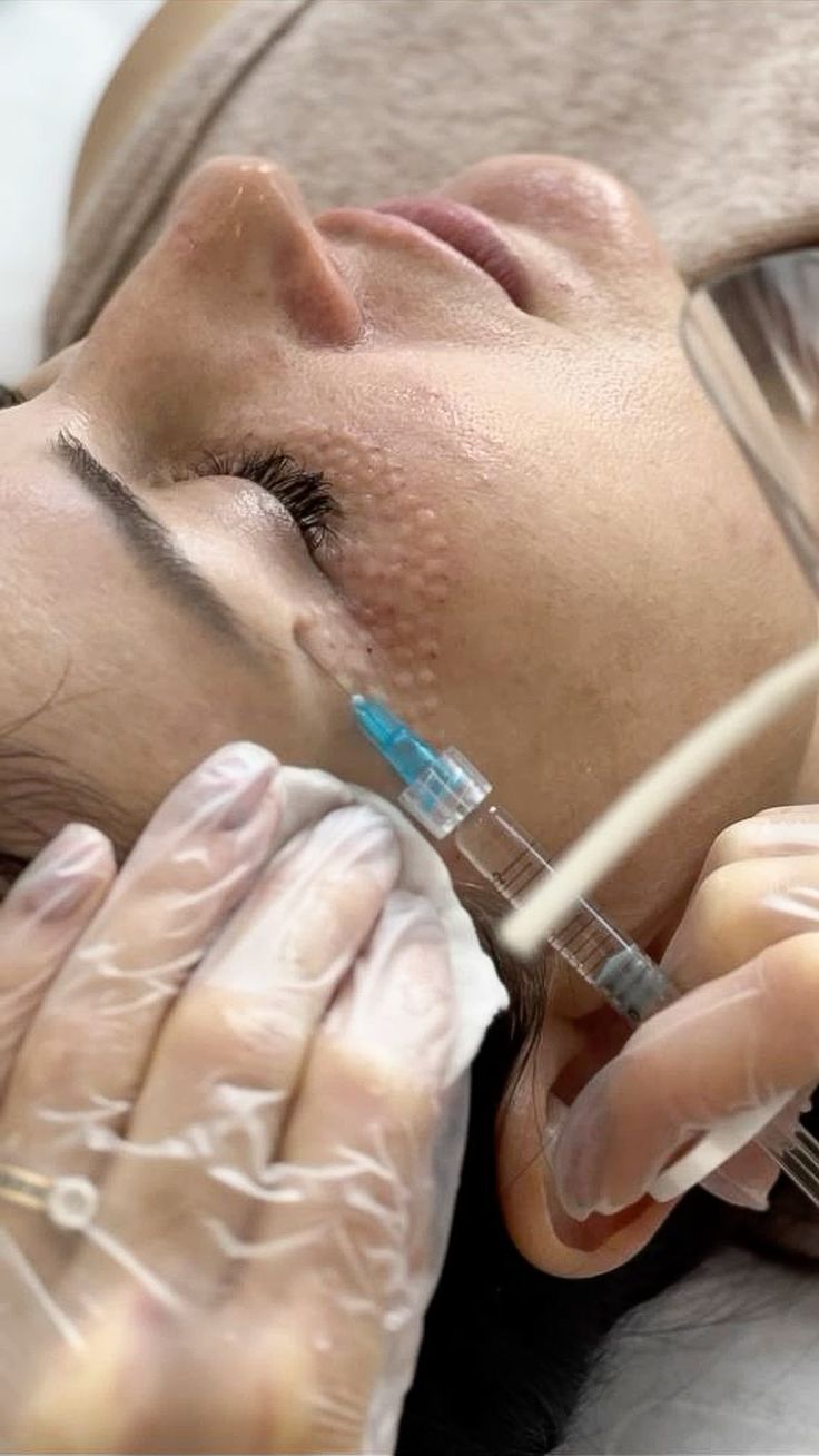 Mezoterapi – klinik tedavi galeri görseli 3