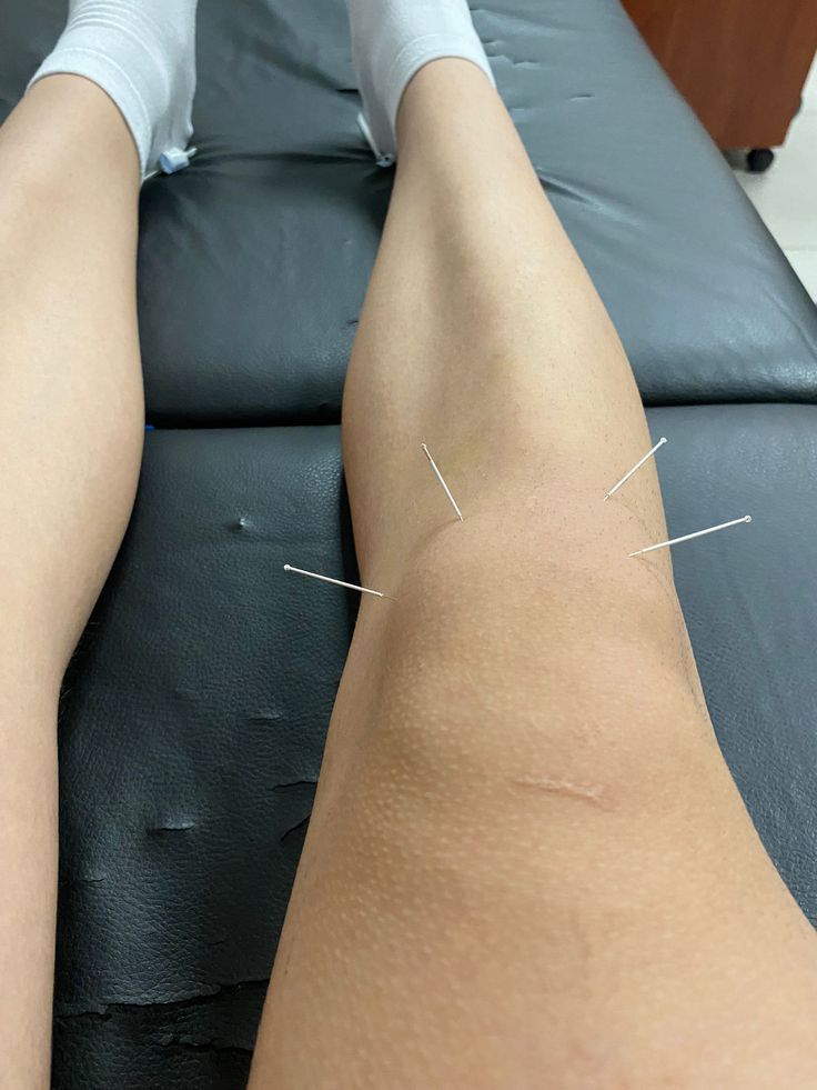 Akupunktur – klinik tedavi galeri görseli 1