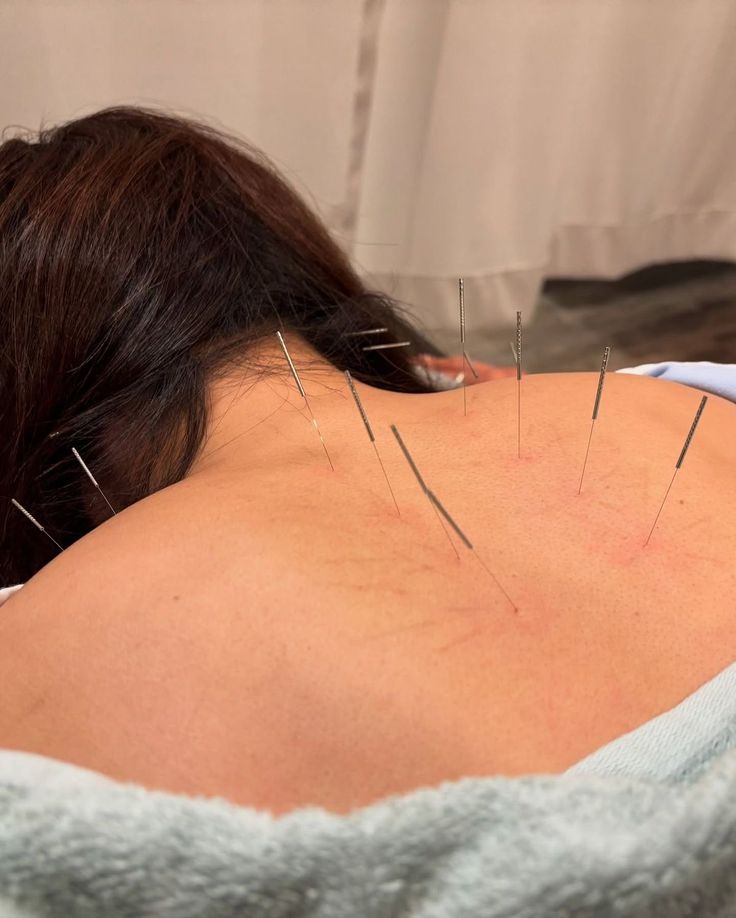 Akupunktur – klinik tedavi galeri görseli 3