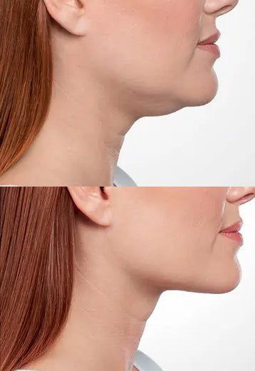 Gıdı Eritme – klinik tedavi galeri görseli 1