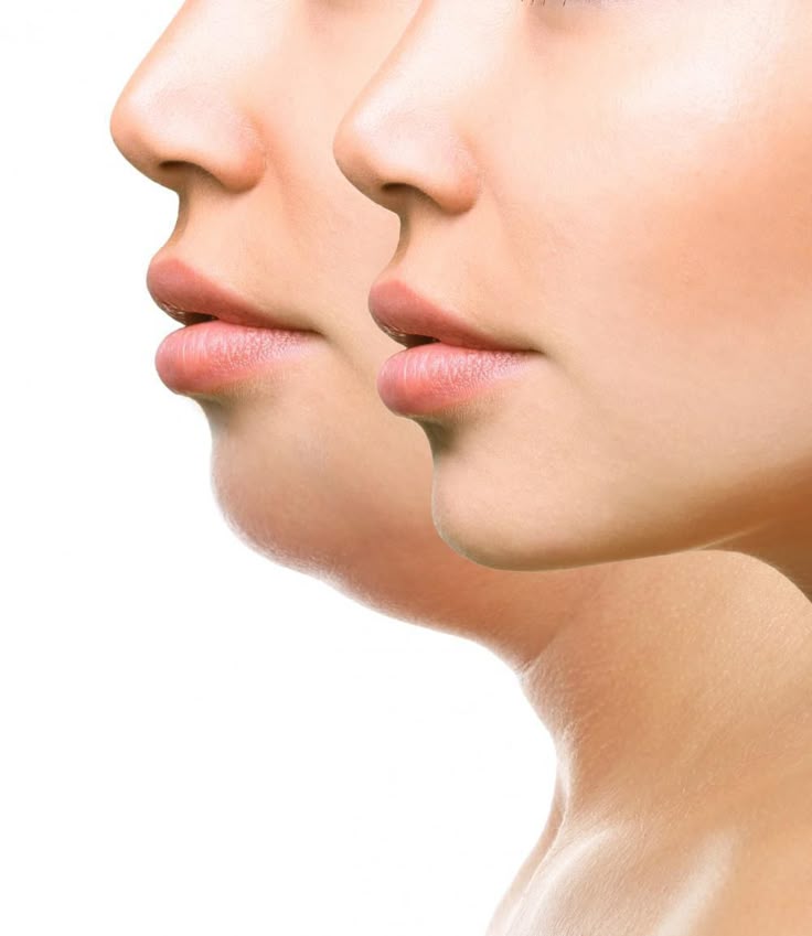 Gıdı Eritme – klinik tedavi galeri görseli 2